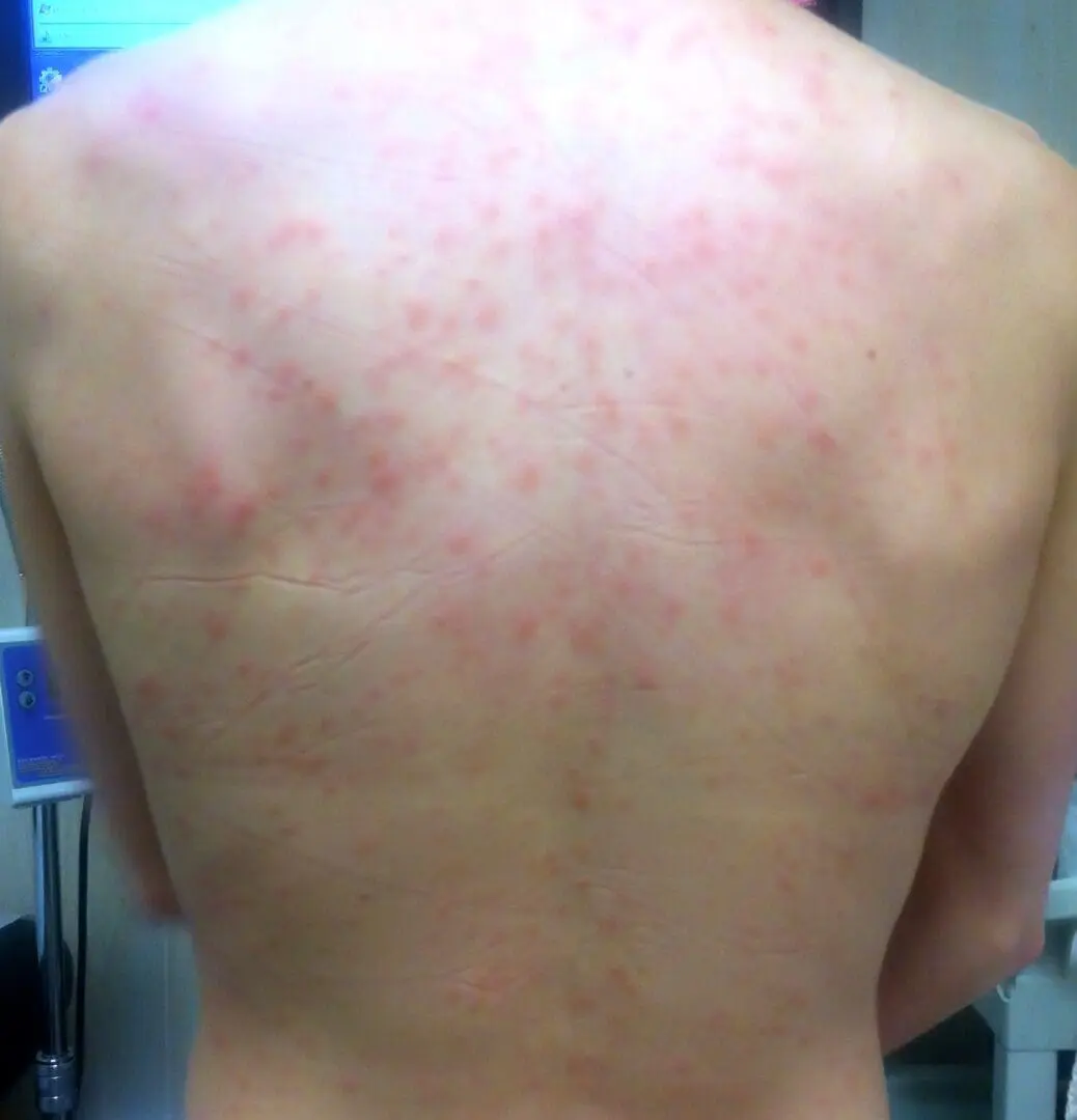 What Can Cause Hives On Stomach And Back