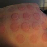 skin reaction after cupping