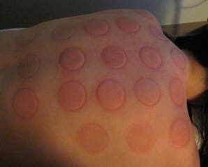 86__320x240_cupping-skin-reaction