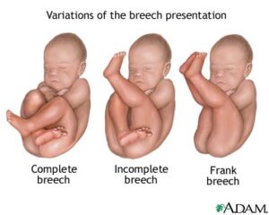 the types of breech presentation
