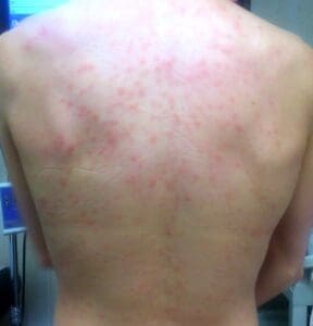 skin hive on the back urticaria