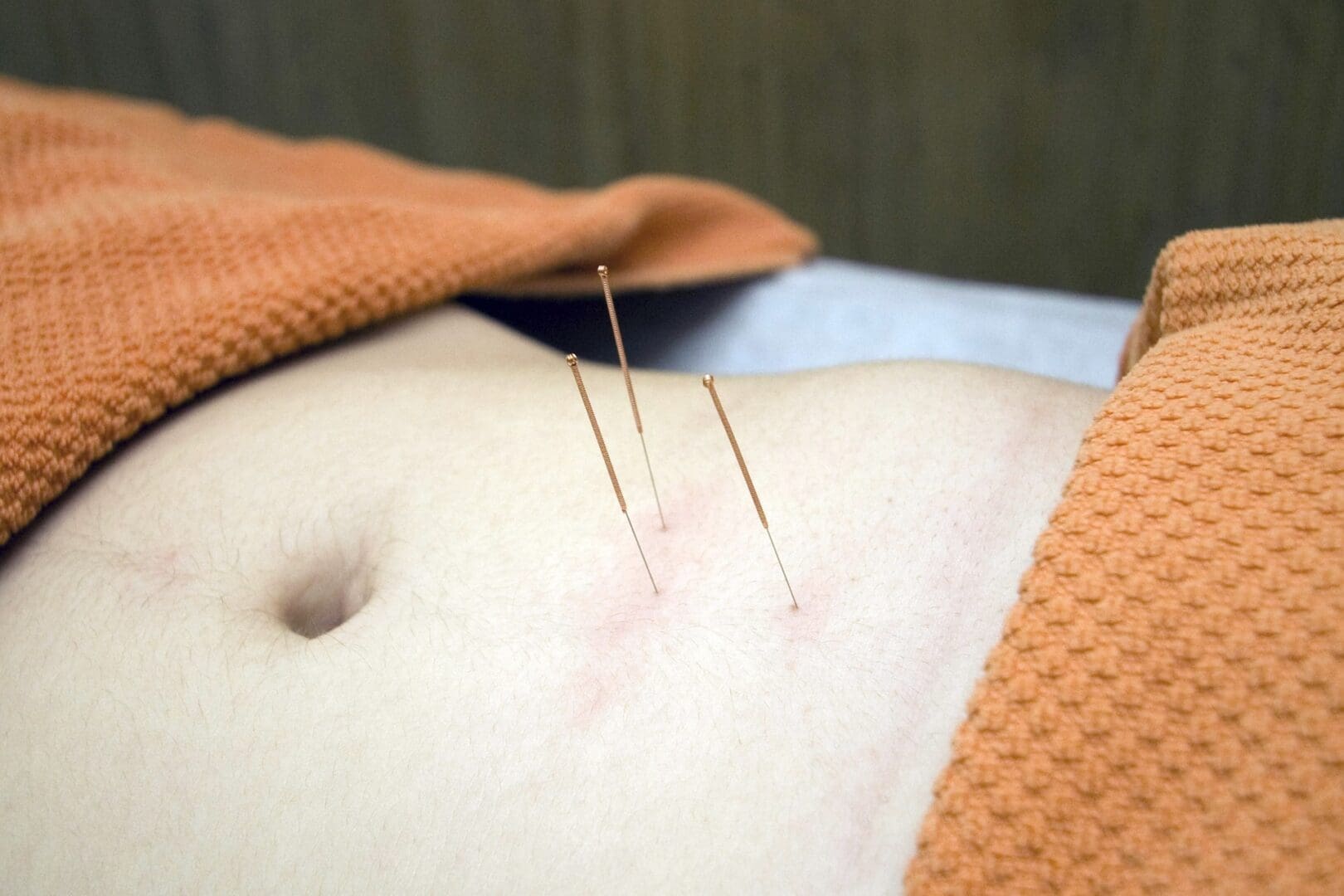 A person is getting their back waxed with acupuncture.